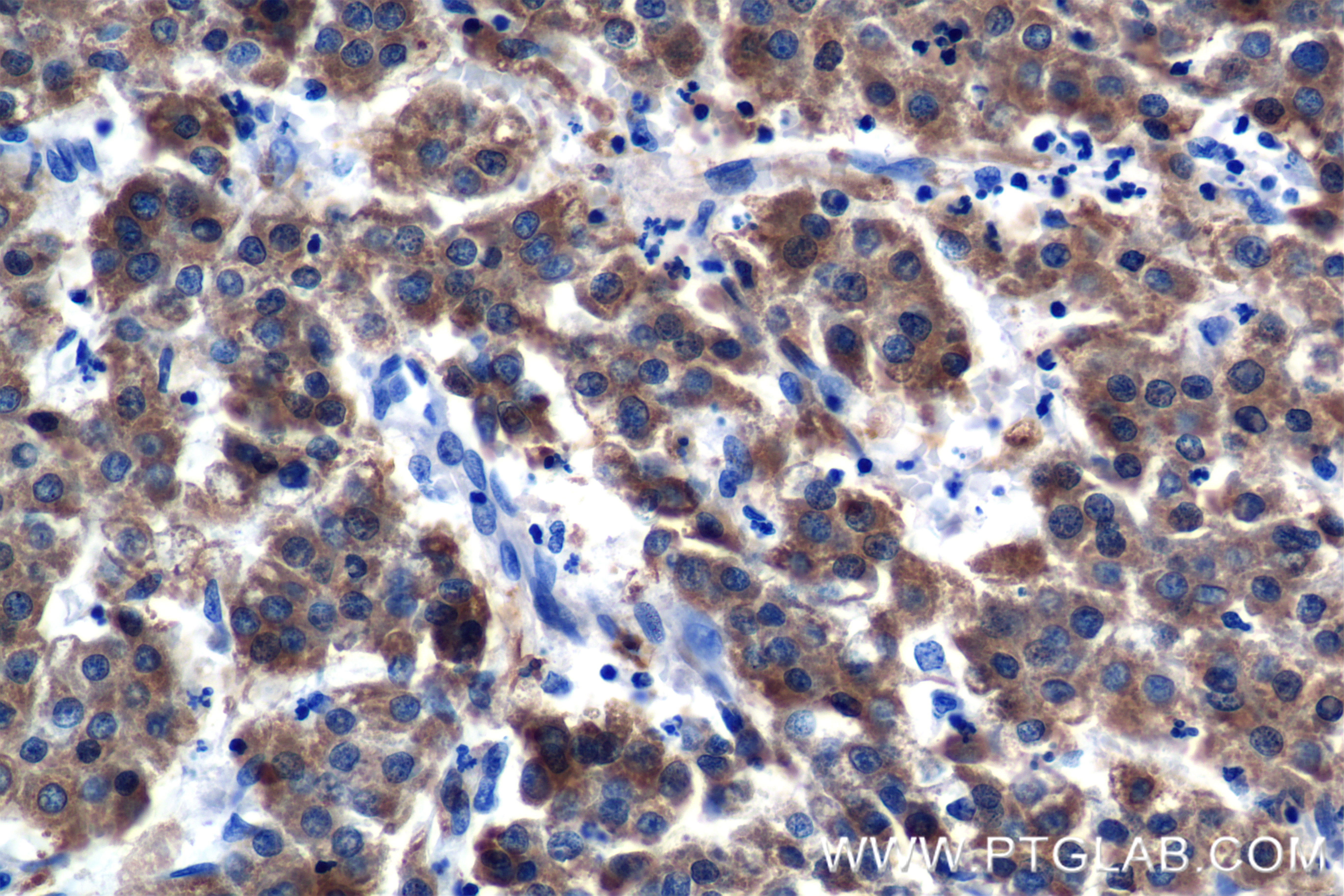 Immunohistochemistry (IHC) staining of Human Hepatocellular cancer using RBP4 Recombinant antibody (84496-4-RR)