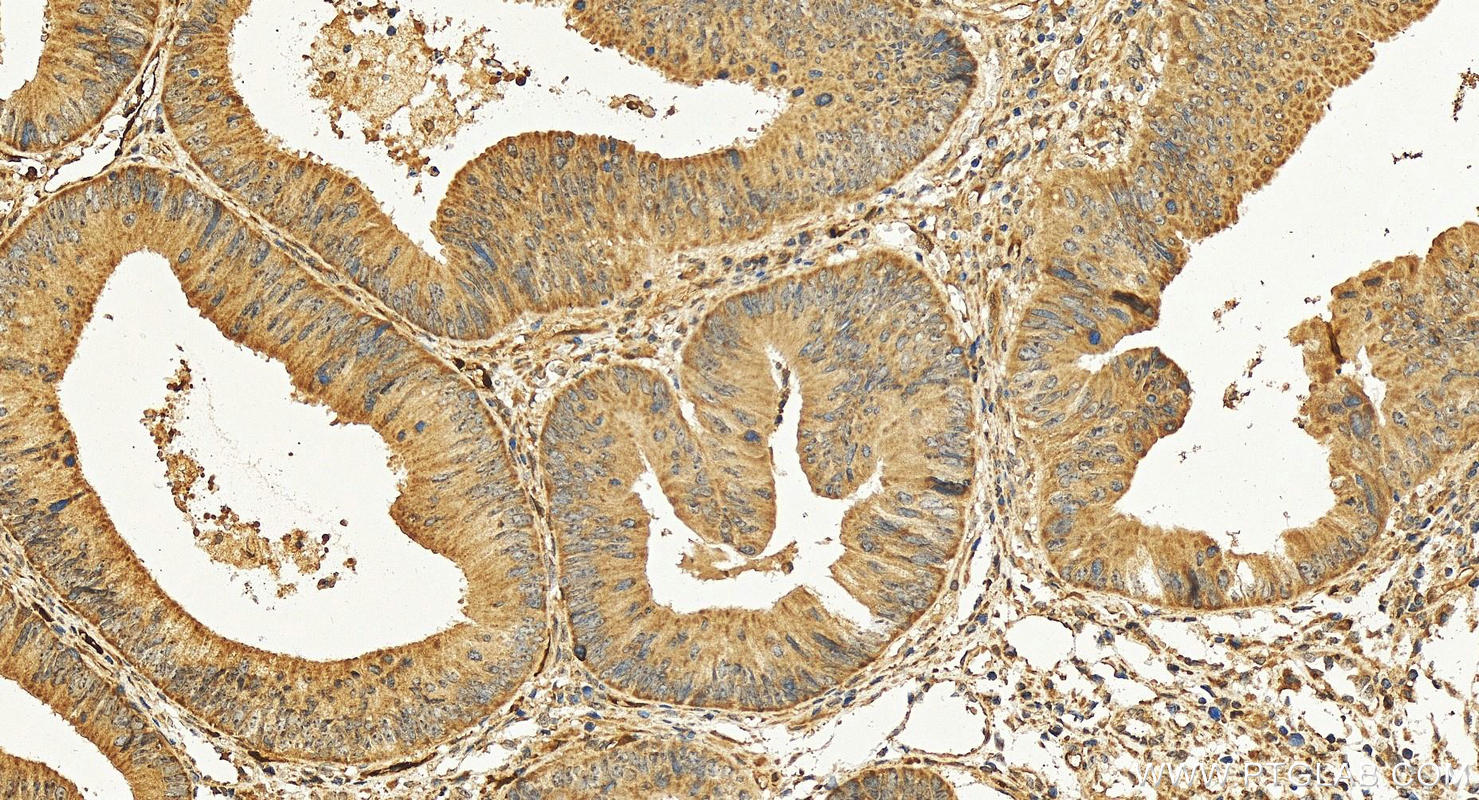 Immunohistochemistry (IHC) staining of human colon cancer tissue using RBP7 Polyclonal antibody (14541-1-AP)