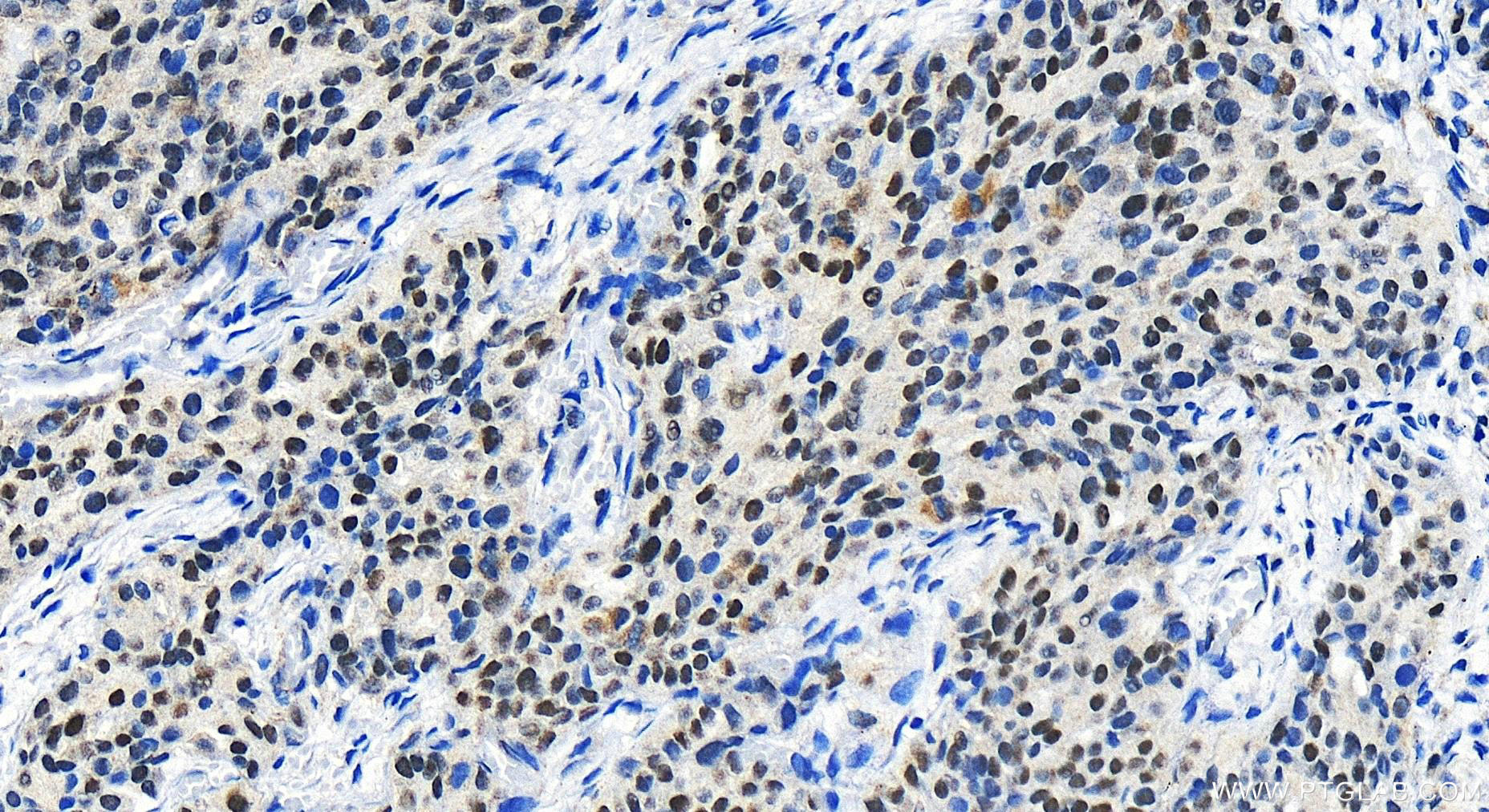 Immunohistochemistry (IHC) staining of human ovary cancer tissue using RCOR1 Polyclonal antibody (27686-1-AP)