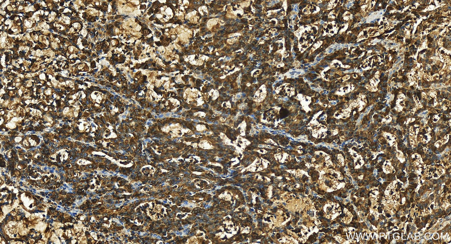 Immunohistochemistry (IHC) staining of human stomach cancer tissue using REG Polyclonal antibody (15850-1-AP)