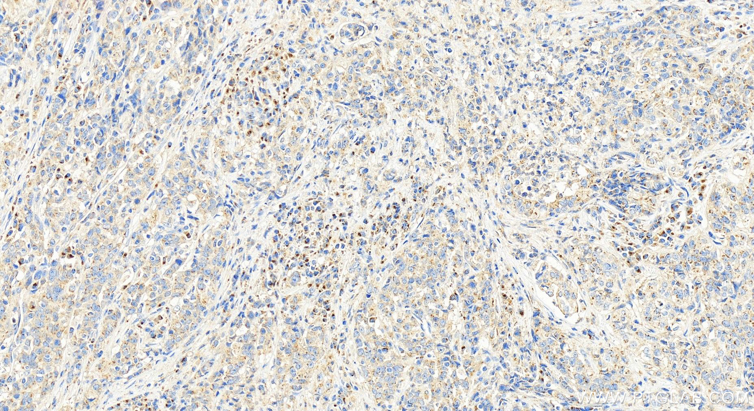 Immunohistochemistry (IHC) staining of human stomach cancer tissue using REG Polyclonal antibody (15850-1-AP)