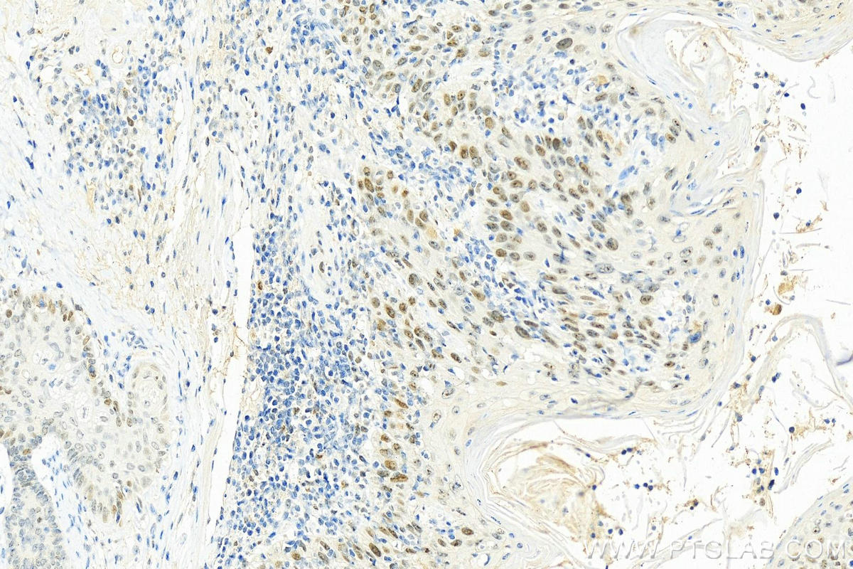 Immunohistochemistry (IHC) staining of human skin cancer tissue using RFC4 Polyclonal antibody (10806-1-AP)