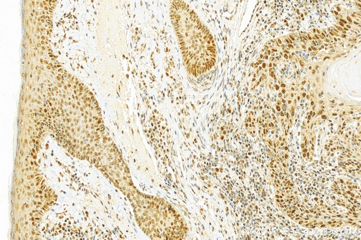 Immunohistochemistry (IHC) staining of human skin cancer tissue using RFC4 Polyclonal antibody (10806-1-AP)