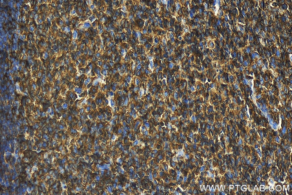 Immunohistochemistry (IHC) staining of human tonsillitis tissue using RFTN1 Polyclonal antibody (24289-1-AP)