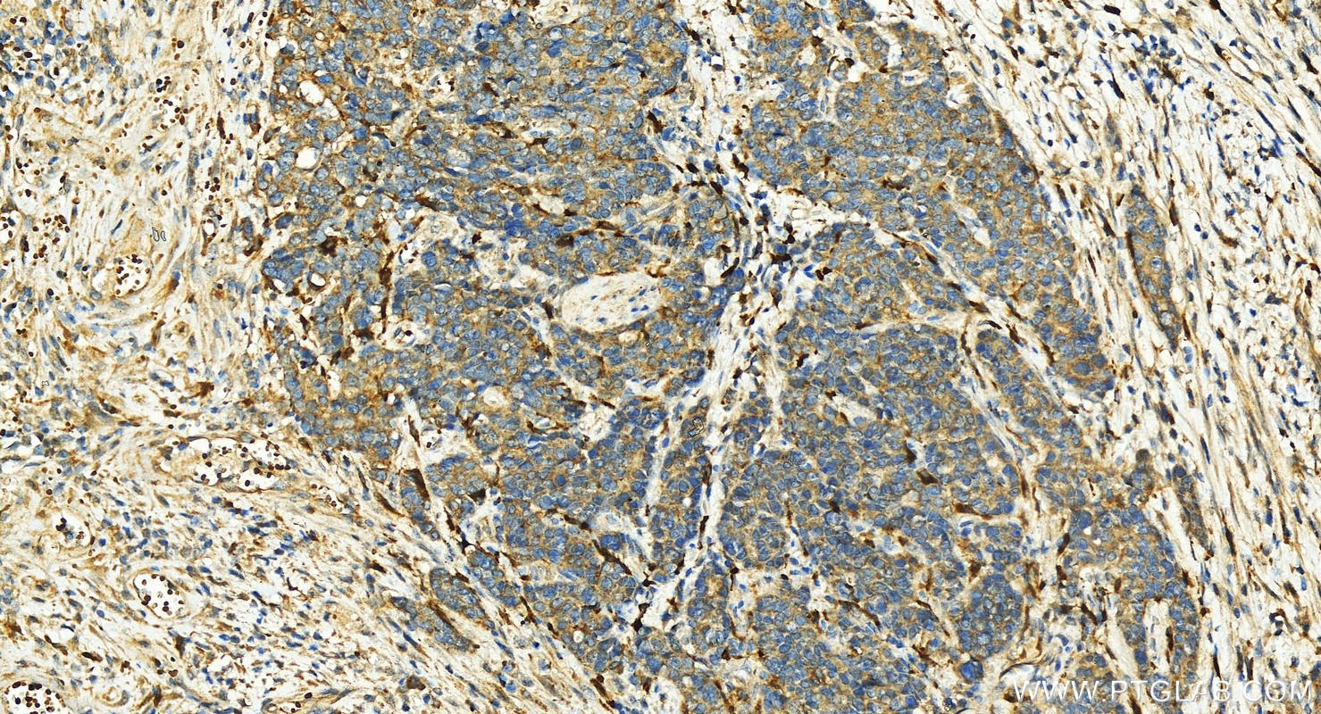 Immunohistochemistry (IHC) staining of human stomach cancer tissue using RGS2 Polyclonal antibody (10678-1-AP)