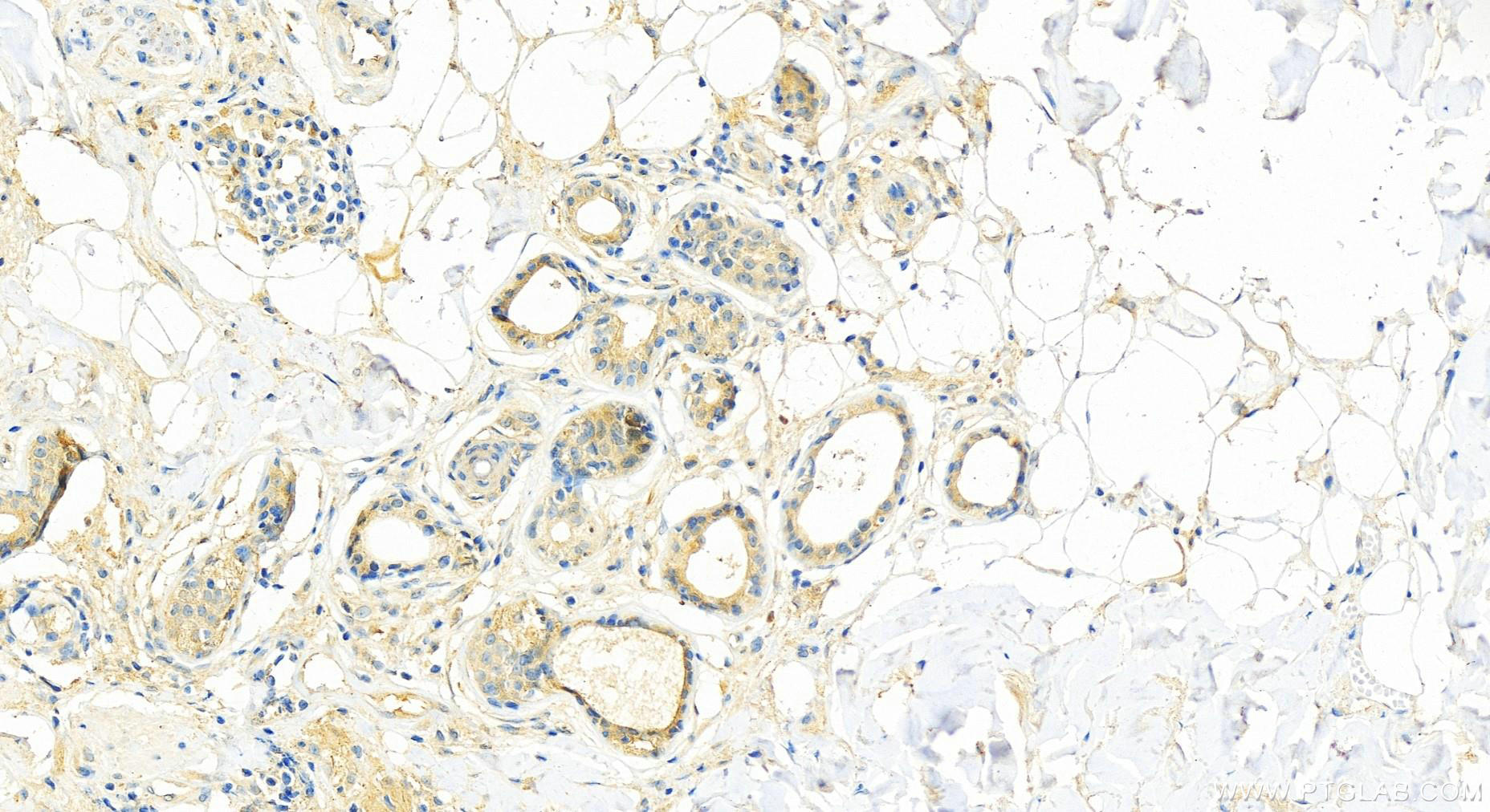 Immunohistochemistry (IHC) staining of human skin cancer tissue using RHEB Monoclonal antibody (66714-1-Ig)