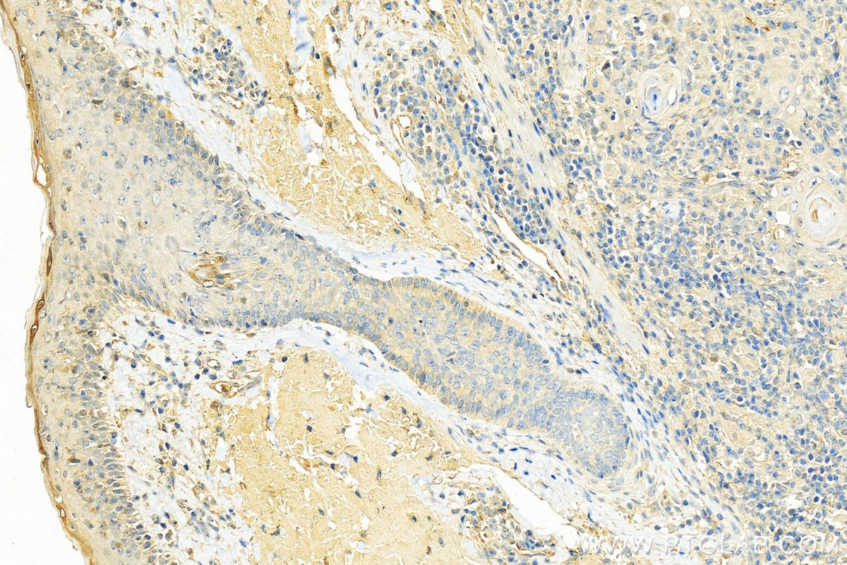 Immunohistochemistry (IHC) staining of human skin cancer tissue using RHOC Polyclonal antibody (10632-1-AP)