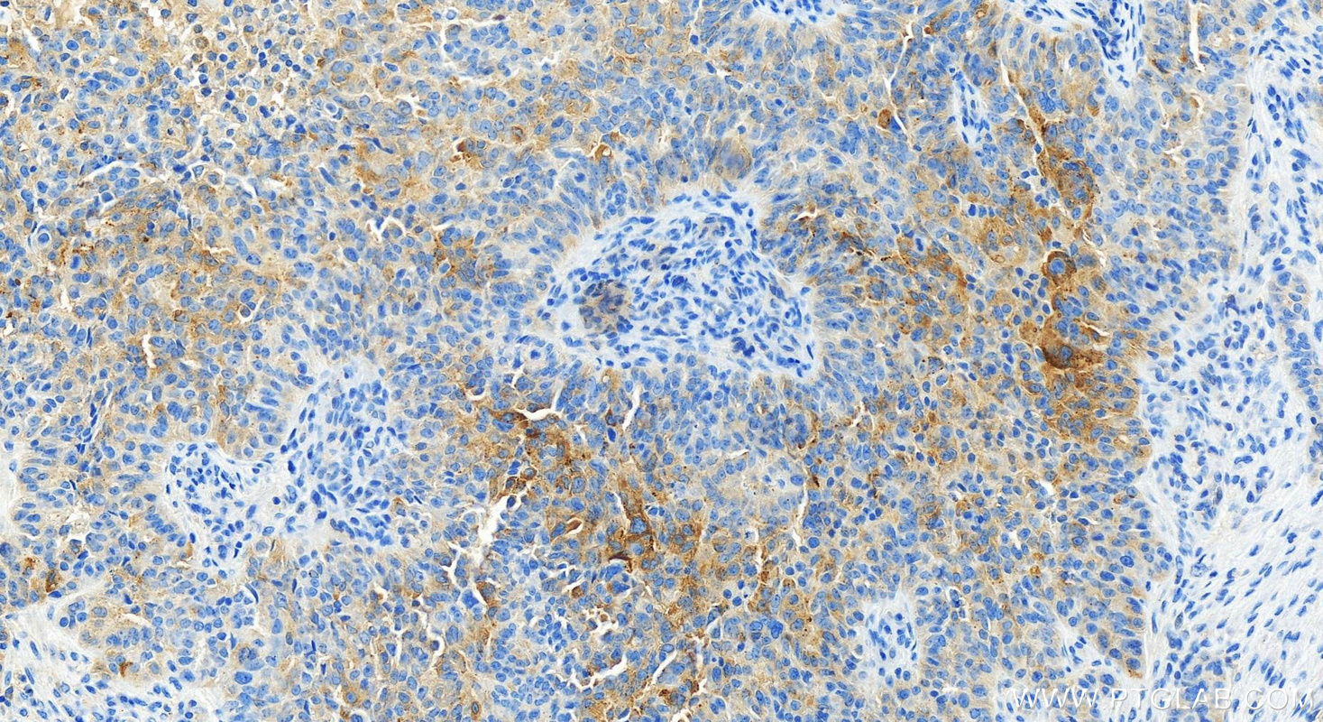 Immunohistochemistry (IHC) staining of human ovarian  cancer using RILP Recombinant antibody (82996-4-RR)