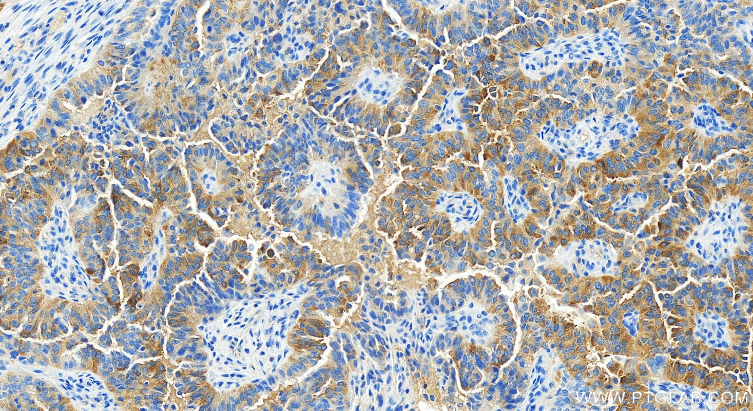 Immunohistochemistry (IHC) staining of human ovarian  cancer using RILP Recombinant antibody (82996-4-RR)