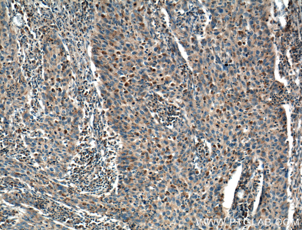 Immunohistochemistry (IHC) staining of human cervical cancer tissue using RIPK4 Polyclonal antibody (26458-1-AP)