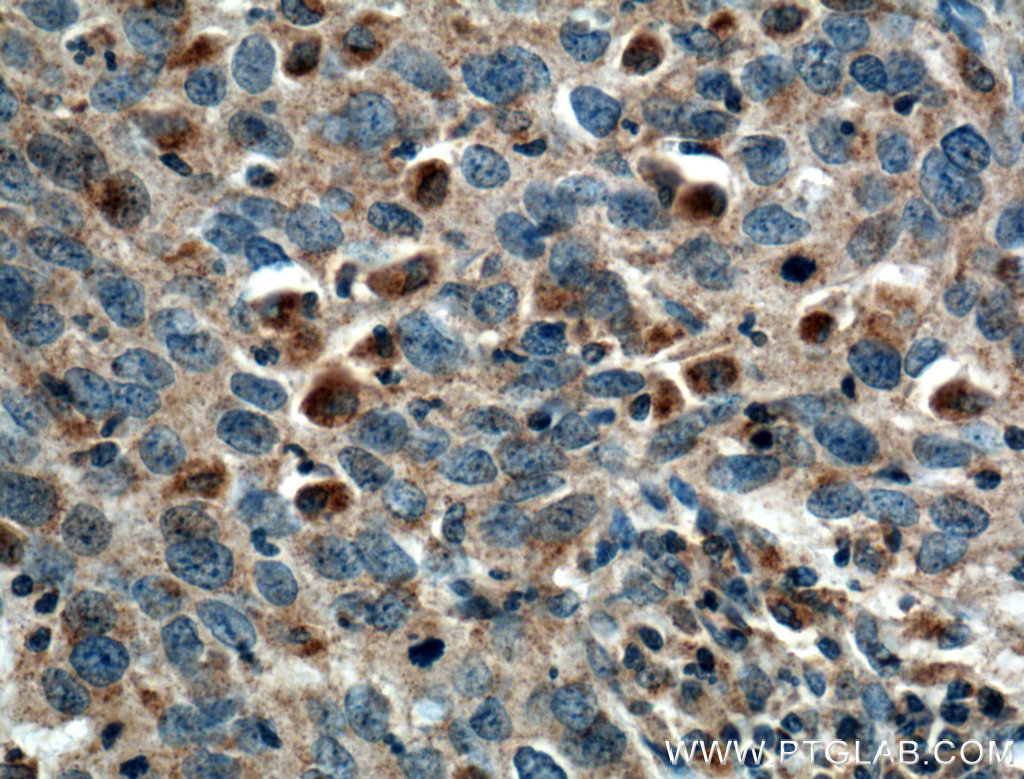 Immunohistochemistry (IHC) staining of human cervical cancer tissue using RIPK4 Polyclonal antibody (26458-1-AP)