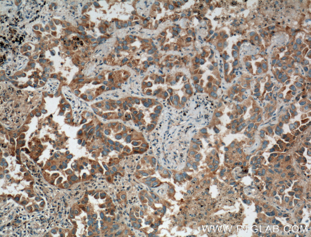 Immunohistochemistry (IHC) staining of human lung cancer tissue using RIPK4 Polyclonal antibody (26458-1-AP)