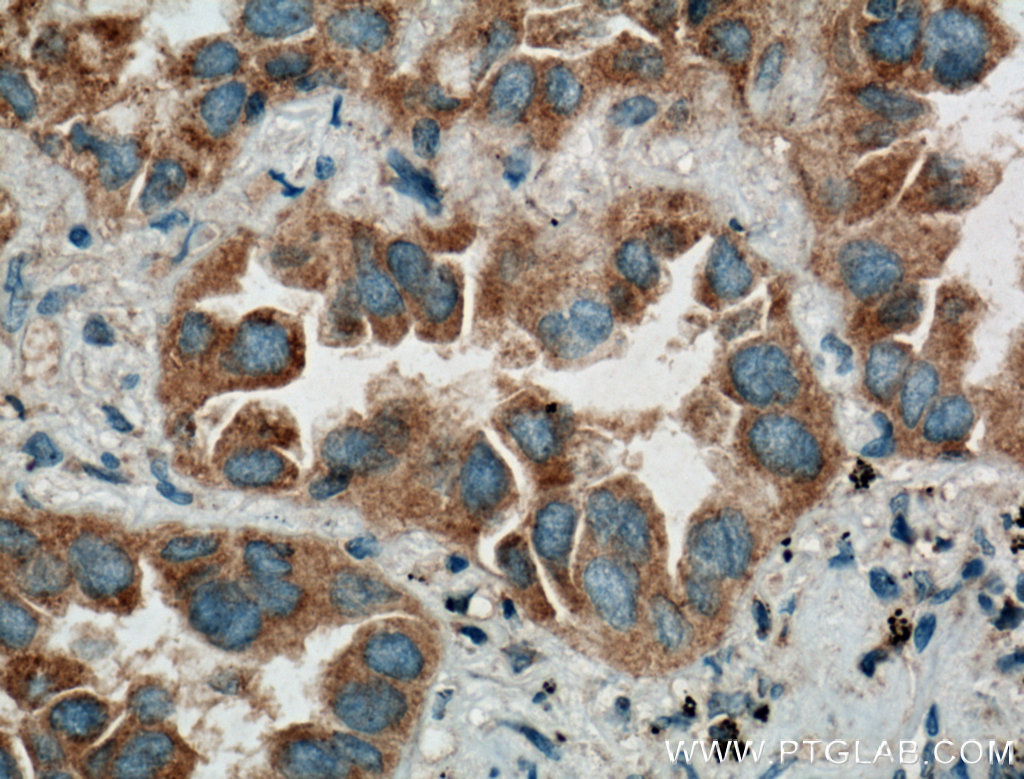 Immunohistochemistry (IHC) staining of human lung cancer tissue using RIPK4 Polyclonal antibody (26458-1-AP)