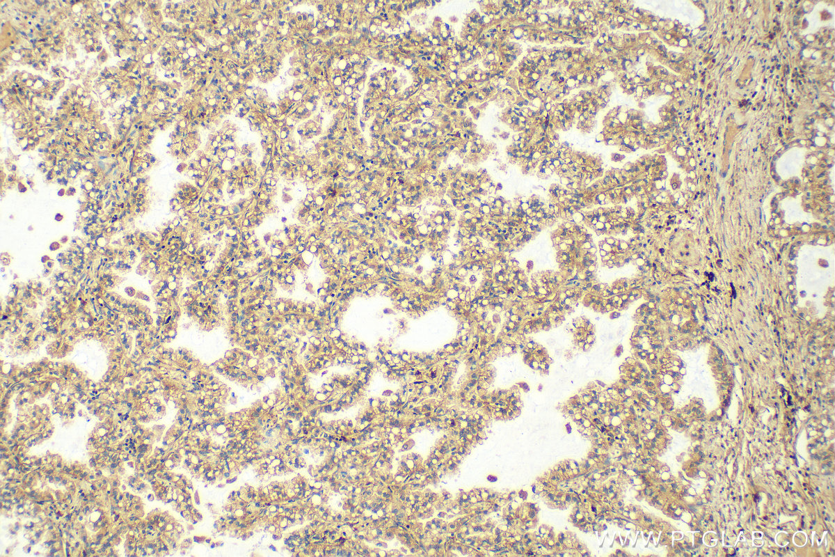 Immunohistochemistry (IHC) staining of human lung cancer tissue using RMI1 Polyclonal antibody (14630-1-AP)