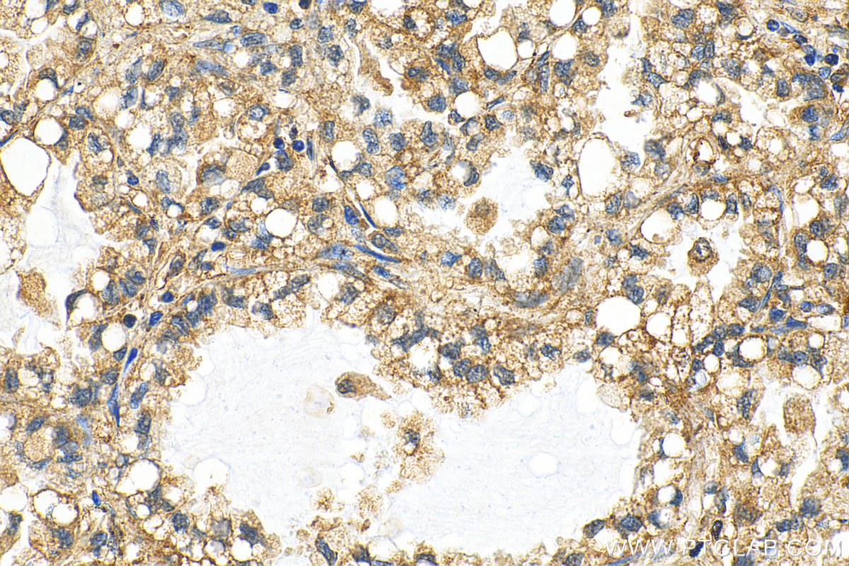 Immunohistochemistry (IHC) staining of human lung cancer tissue using RMI1 Polyclonal antibody (14630-1-AP)