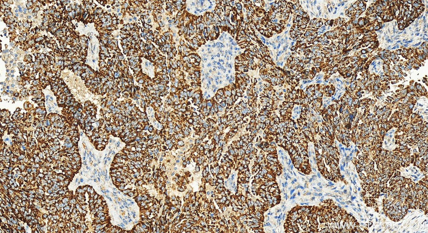 Immunohistochemistry (IHC) staining of human ovarian  cancer using RNASEH1 Recombinant antibody (82771-1-RR)