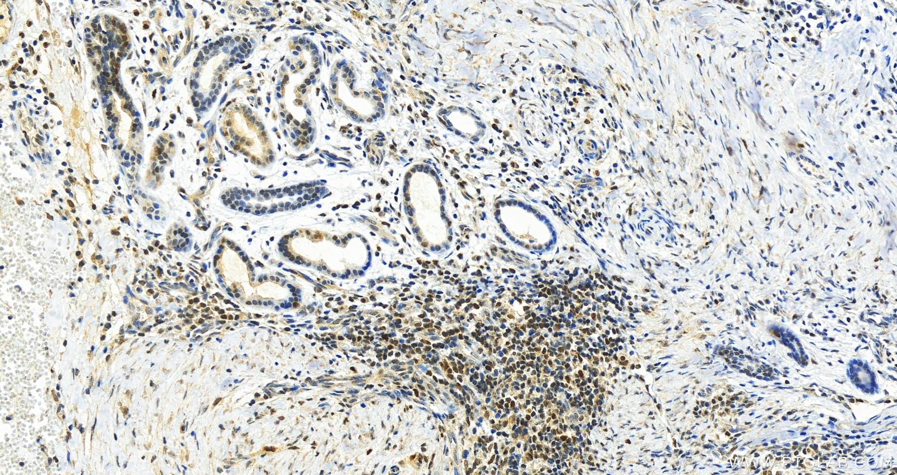 Immunohistochemistry (IHC) staining of human skin cancer tissue using RNASEH2A Monoclonal antibody (67976-1-Ig)