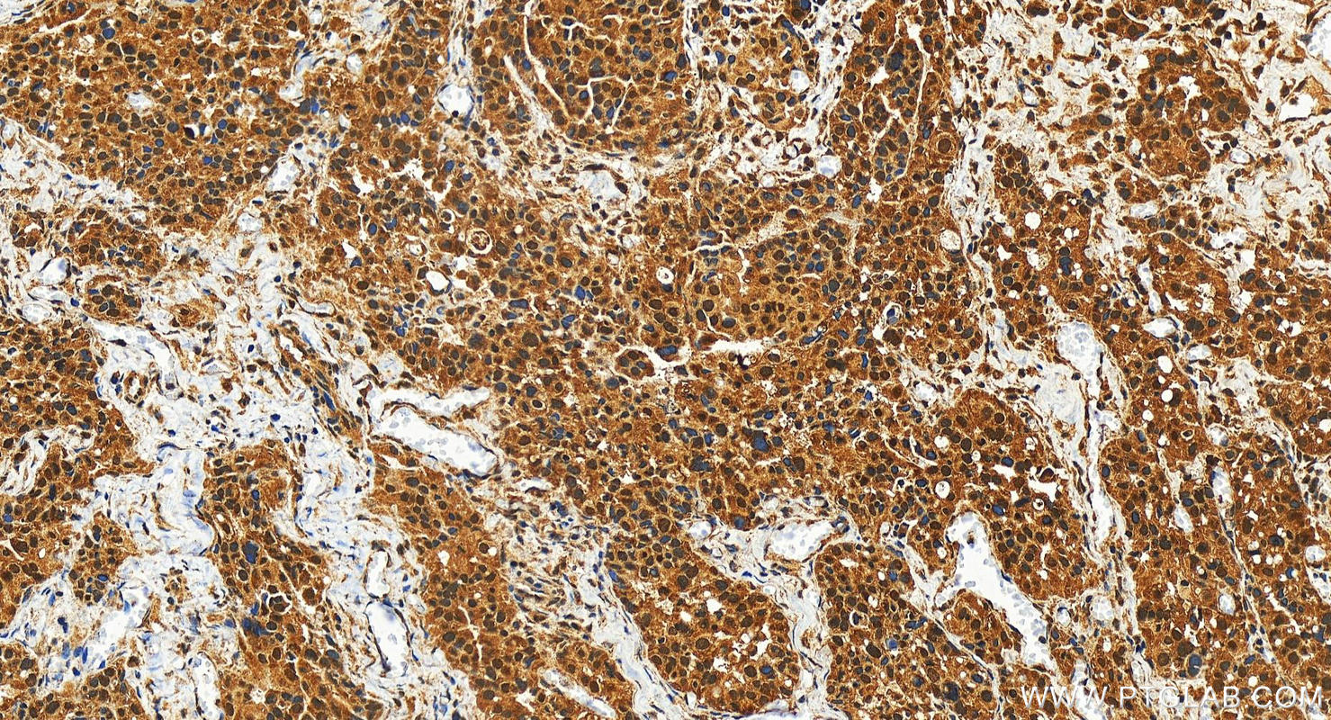 Immunohistochemistry (IHC) staining of human ovary cancer tissue using RNF113A Polyclonal antibody (27018-1-AP)