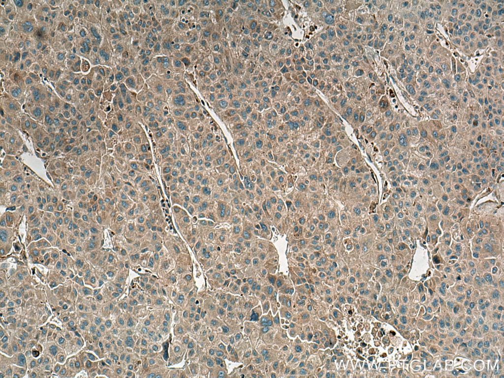 Immunohistochemistry (IHC) staining of human liver cancer tissue using ROCK2-Specific(C-term) Polyclonal antibody (20248-1-AP)