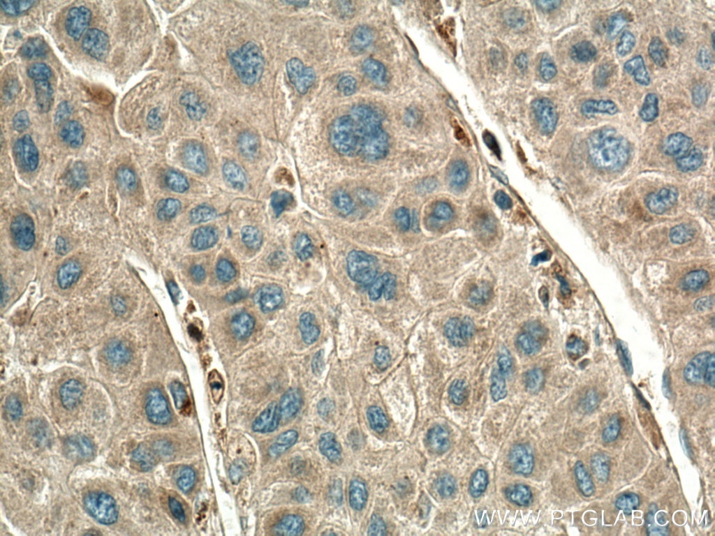Immunohistochemistry (IHC) staining of human liver cancer tissue using ROCK2-Specific(C-term) Polyclonal antibody (20248-1-AP)