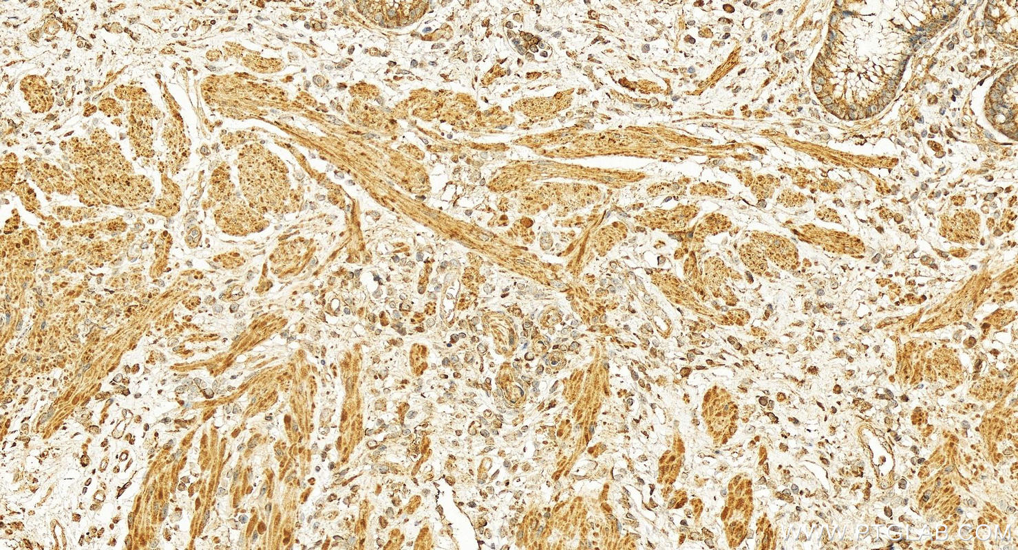 Immunohistochemistry (IHC) staining of human colon cancer tissue using ROPN1L Polyclonal antibody (12565-1-AP)