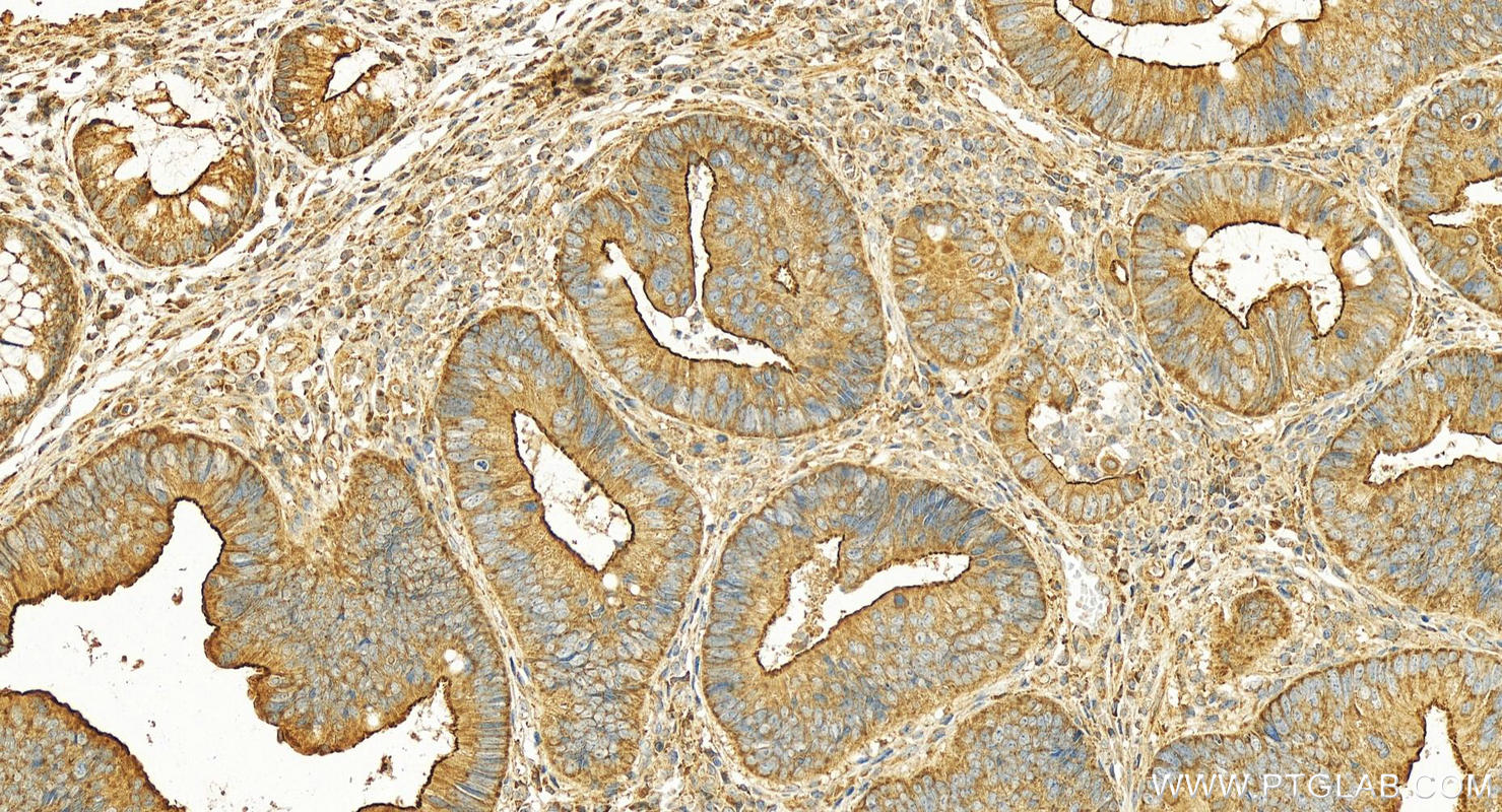 Immunohistochemistry (IHC) staining of human colon cancer tissue using ROPN1L Polyclonal antibody (12565-1-AP)