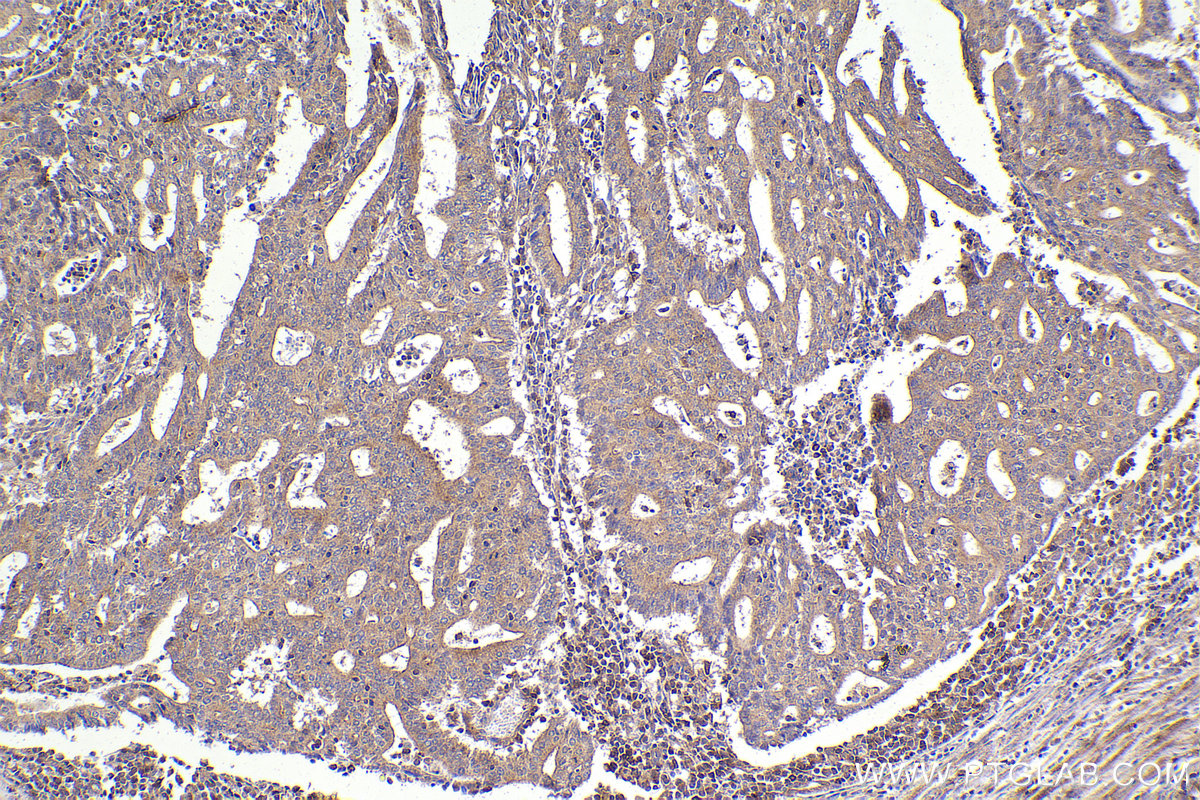 Immunohistochemistry (IHC) staining of human endometrial cancer tissue using RPL12 Polyclonal antibody (14536-1-AP)