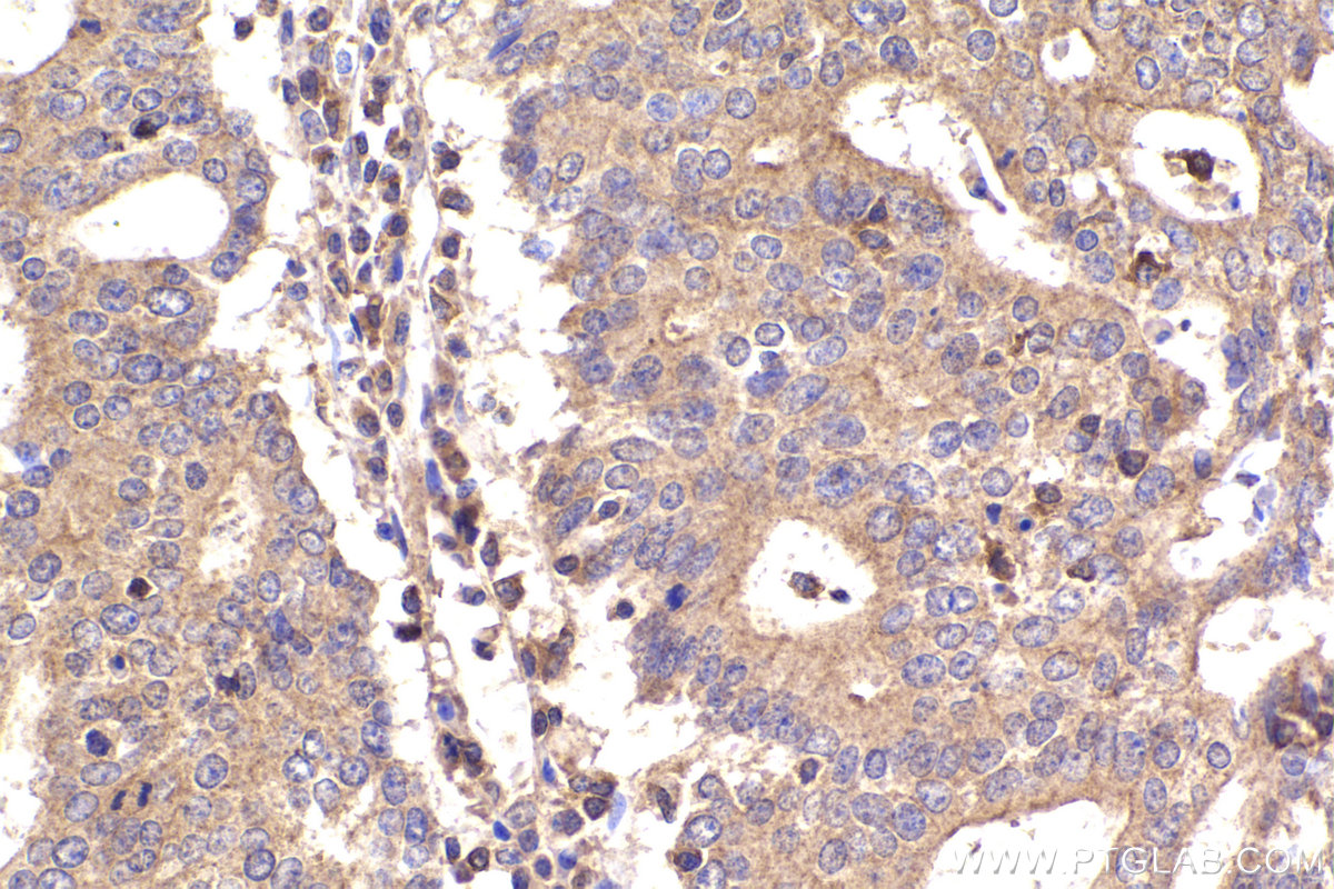 Immunohistochemistry (IHC) staining of human endometrial cancer tissue using RPL12 Polyclonal antibody (14536-1-AP)