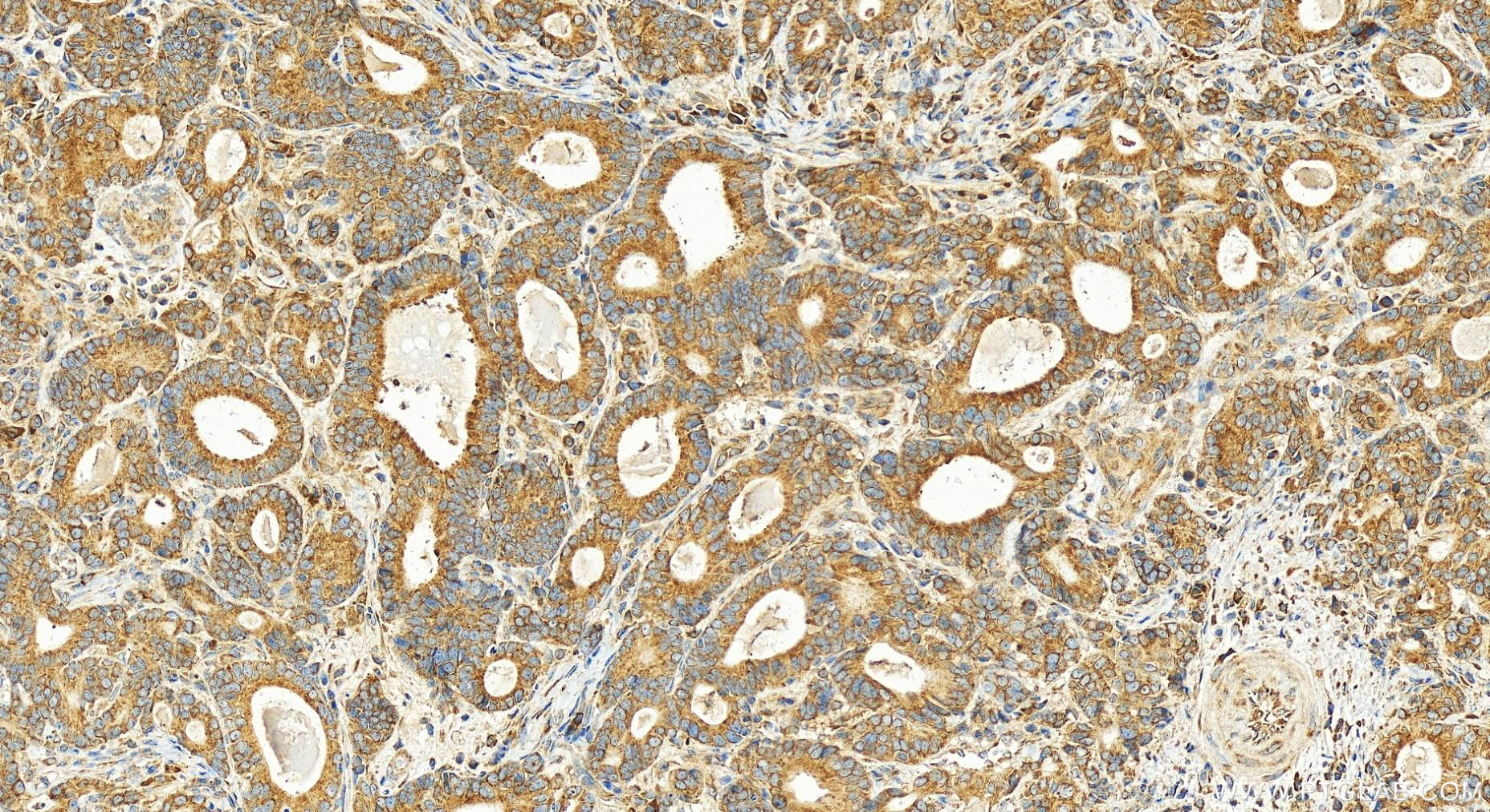 Immunohistochemistry (IHC) staining of human stomach cancer tissue using RPL13A Polyclonal antibody (14633-1-AP)