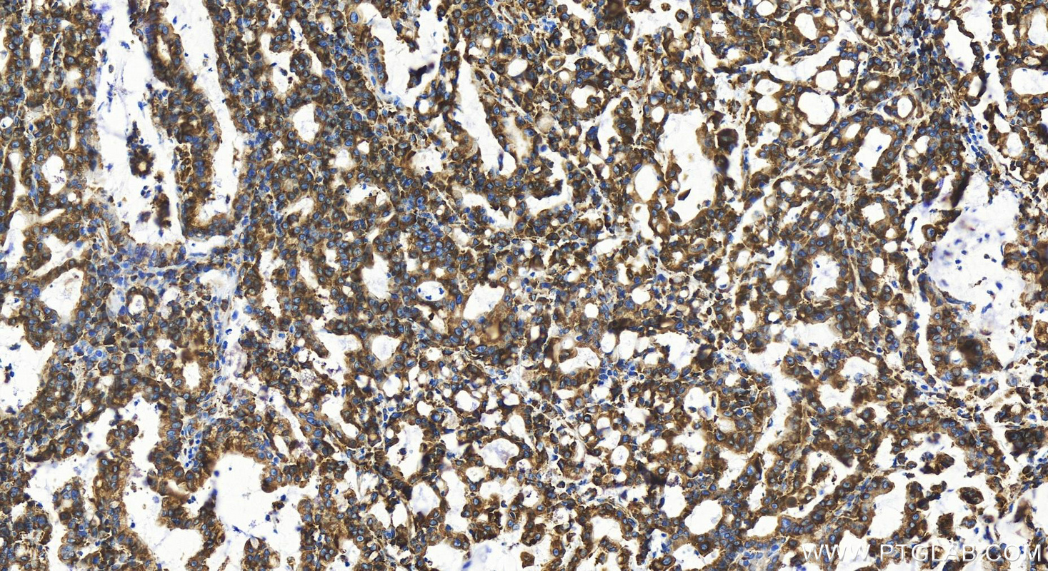 Immunohistochemistry (IHC) staining of human stomach cancer tissue using RPL18A Recombinant antibody (83928-1-RR)