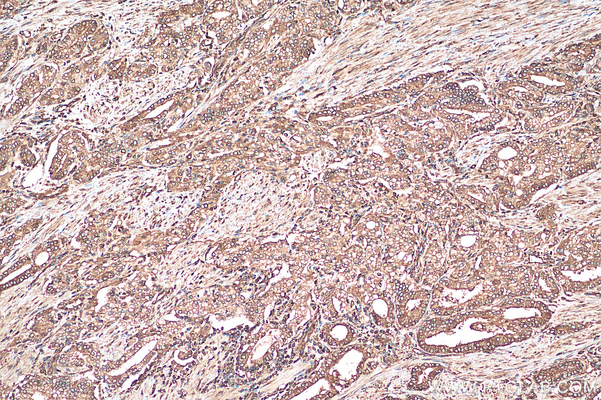 Immunohistochemistry (IHC) staining of human prostate cancer tissue using RPLP1 Polyclonal antibody (21636-1-AP)