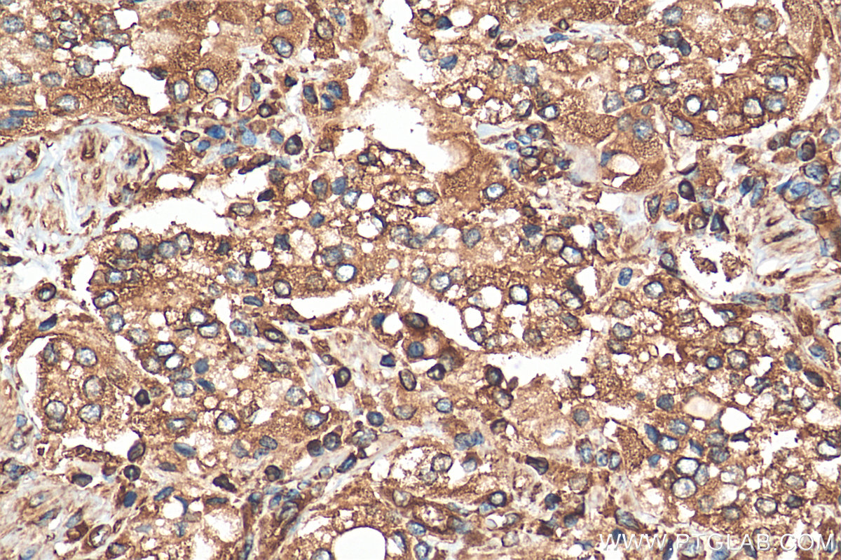 Immunohistochemistry (IHC) staining of human prostate cancer tissue using RPLP1 Polyclonal antibody (21636-1-AP)