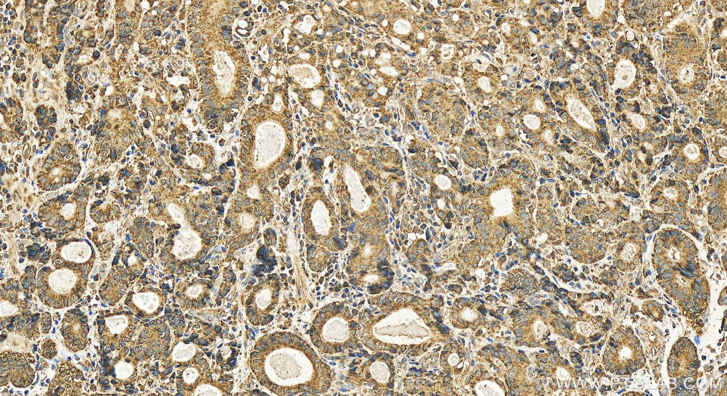 Immunohistochemistry (IHC) staining of human stomach cancer tissue using Ribophorin I Recombinant antibody (83250-2-RR)