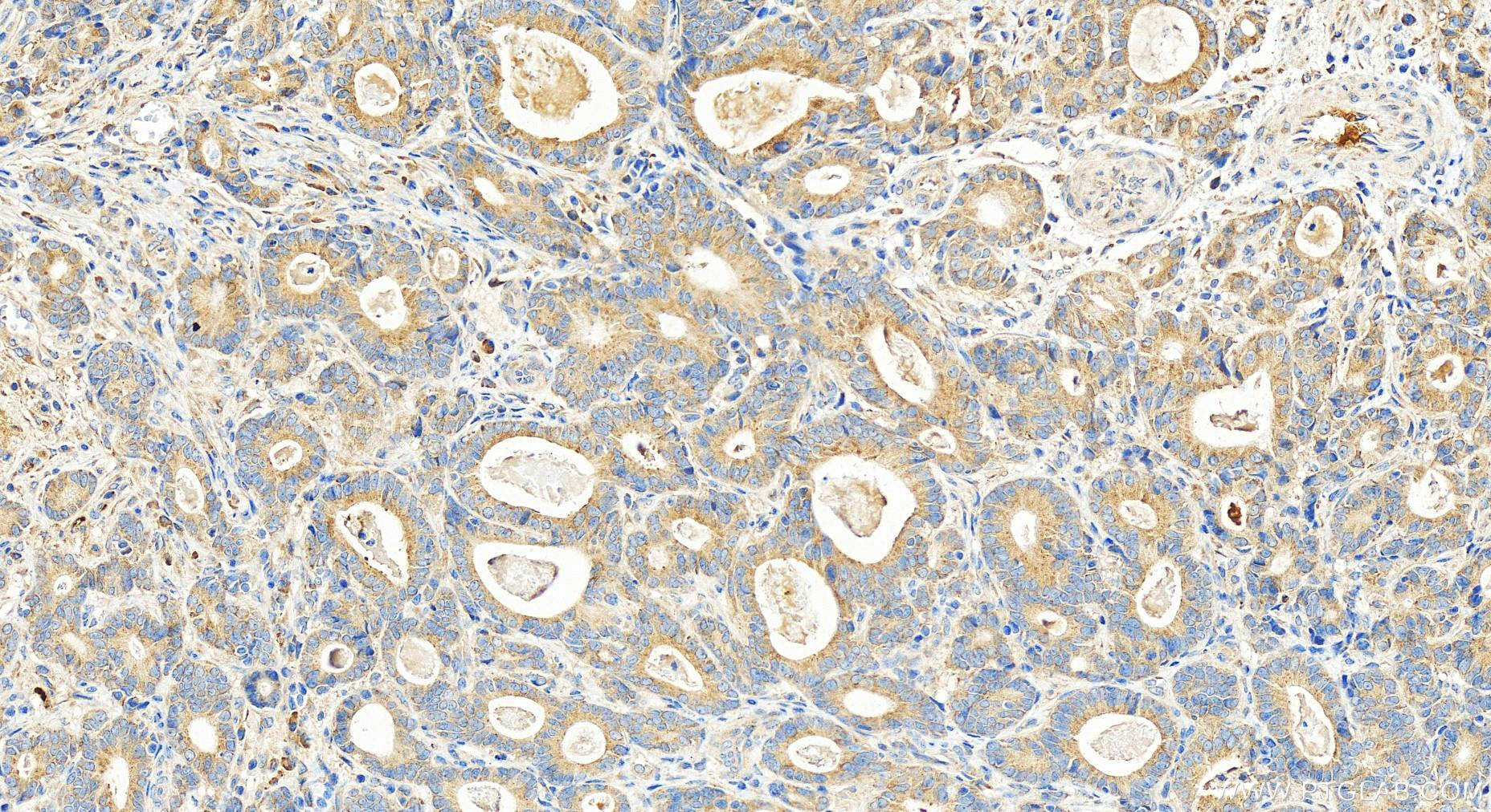 Immunohistochemistry (IHC) staining of human stomach cancer tissue using RPS11 Polyclonal antibody (15942-1-AP)