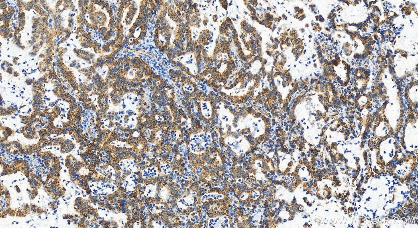 Immunohistochemistry (IHC) staining of human stomach cancer tissue using RPS11 Recombinant antibody (83517-3-RR)