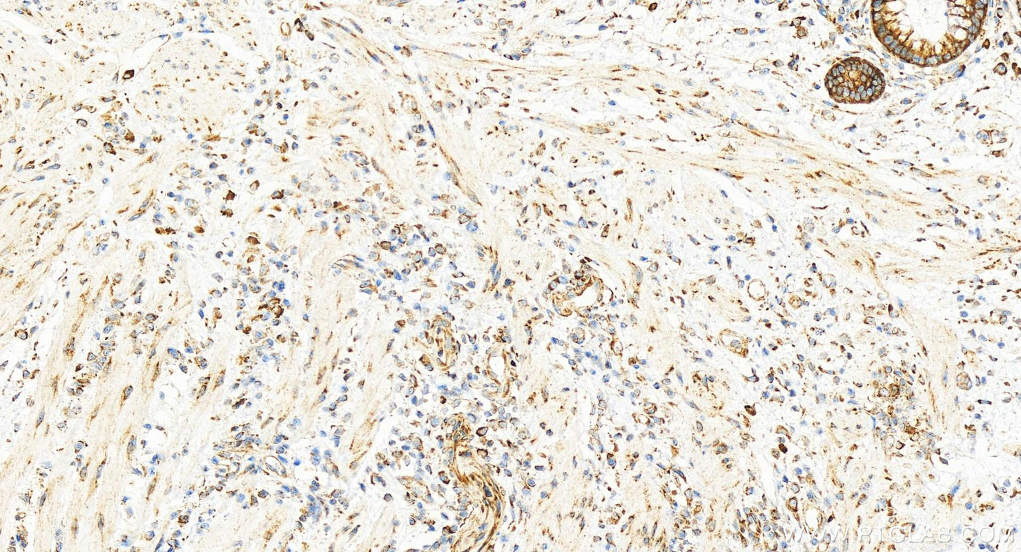 Immunohistochemistry (IHC) staining of human colon cancer tissue using RPS3 Polyclonal antibody (15198-1-AP)