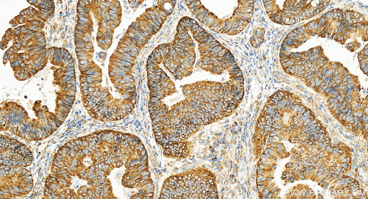 Immunohistochemistry (IHC) staining of human colon cancer tissue using RPS3 Polyclonal antibody (15198-1-AP)