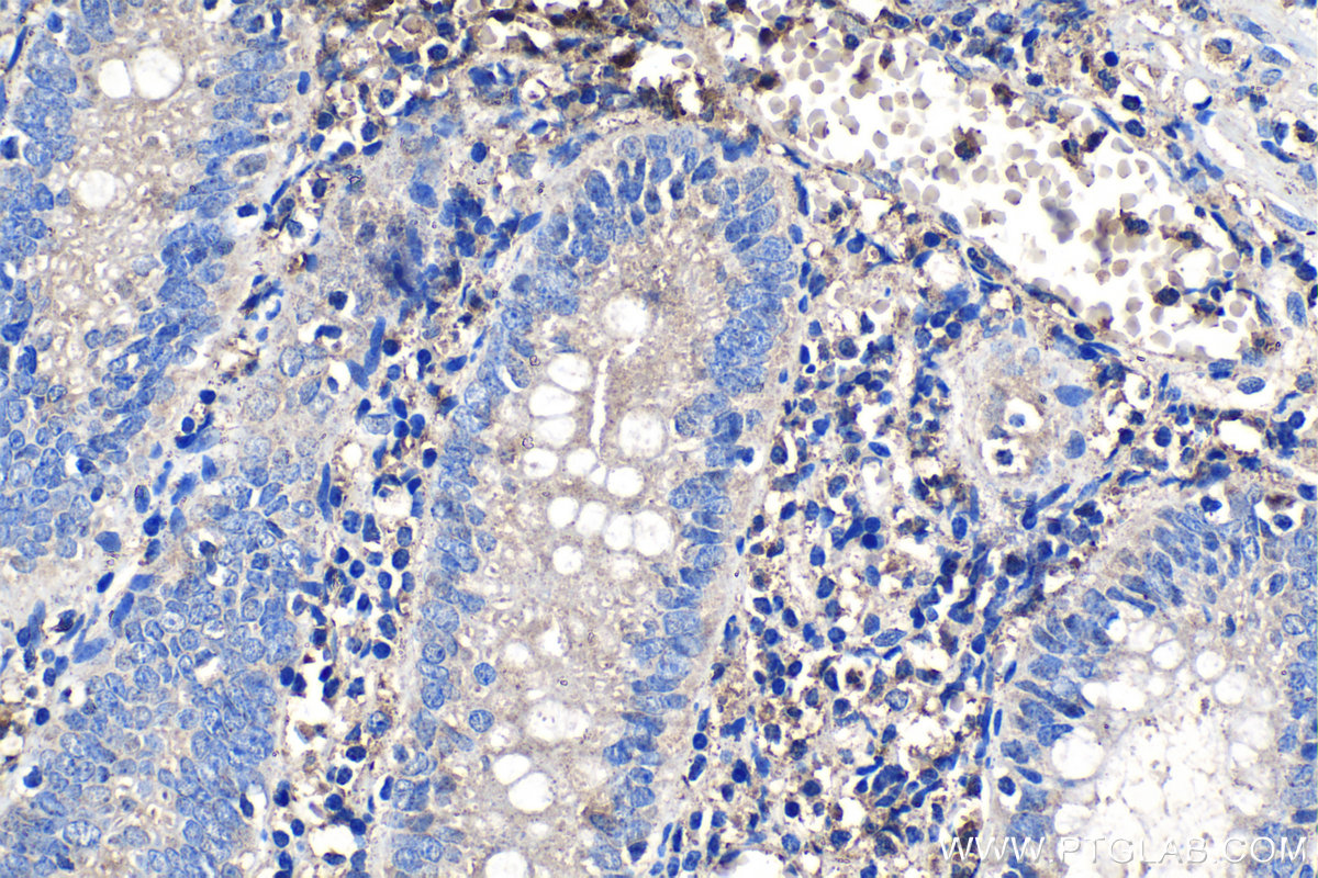 Immunohistochemistry (IHC) staining of human appendicitis tissue using RPS4Y1 Polyclonal antibody (17296-1-AP)