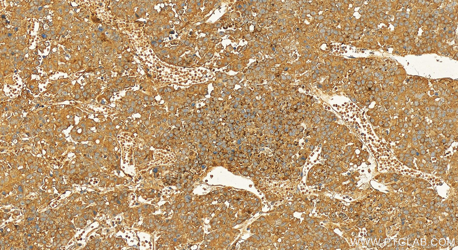 Immunohistochemistry (IHC) staining of human hepatocellular carcinoma using Raptor Polyclonal antibody (20984-1-AP)