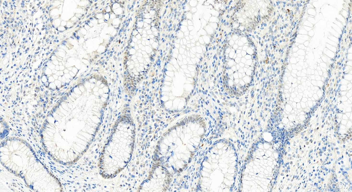 Immunohistochemistry (IHC) staining of human colon cancer tissue using RPUSD2 Polyclonal antibody (25707-1-AP)