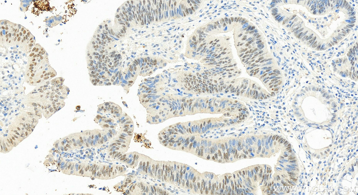 Immunohistochemistry (IHC) staining of human colon cancer tissue using RPUSD2 Polyclonal antibody (25707-1-AP)