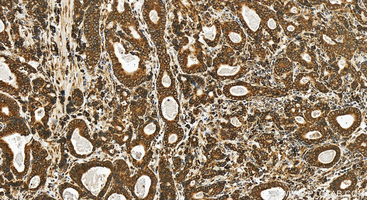 Immunohistochemistry (IHC) staining of human stomach cancer tissue using RRBP1 Recombinant antibody (82890-2-RR)