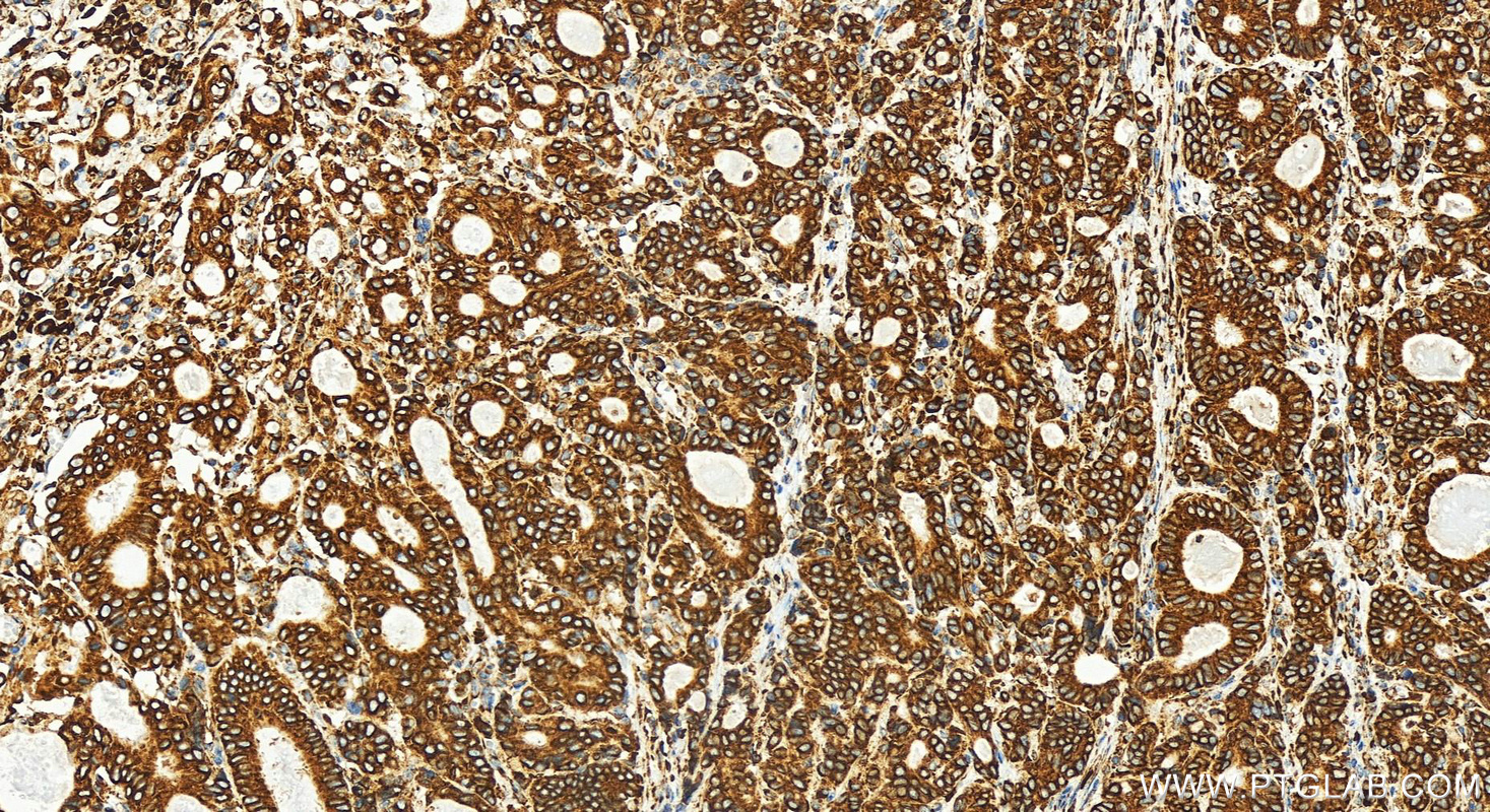 Immunohistochemistry (IHC) staining of human stomach cancer tissue using RRBP1 Recombinant antibody (82890-3-RR)