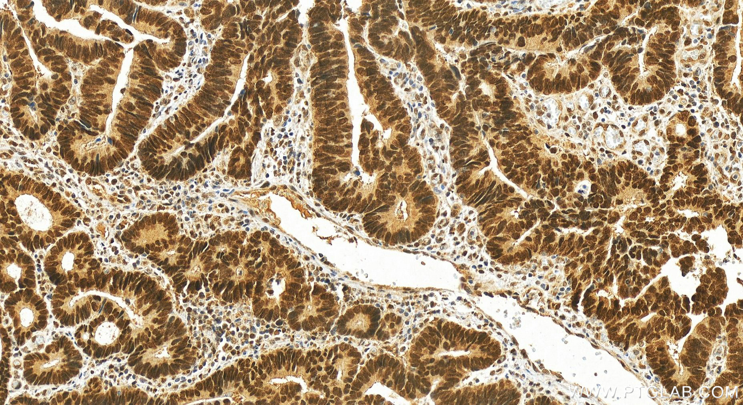 Immunohistochemistry (IHC) staining of human colon cancer tissue using RREB1 Polyclonal antibody (27706-1-AP)