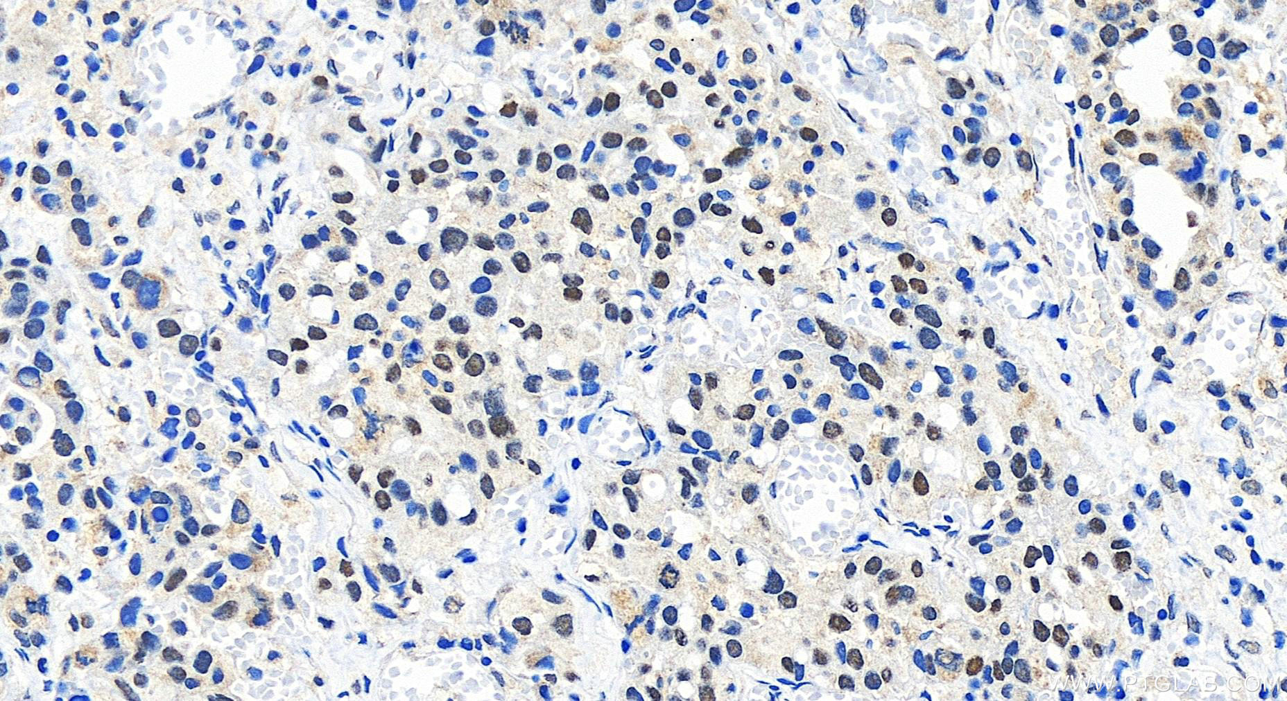 Immunohistochemistry (IHC) staining of human ovary cancer tissue using RREB1 Polyclonal antibody (27706-1-AP)