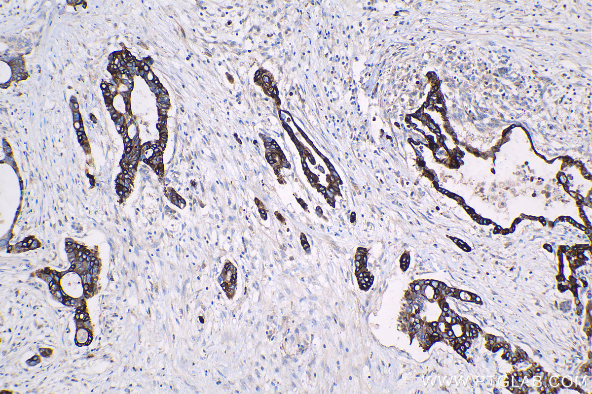 Immunohistochemistry (IHC) staining of human pancreas cancer tissue using RRM1 Monoclonal antibody (60073-2-Ig)