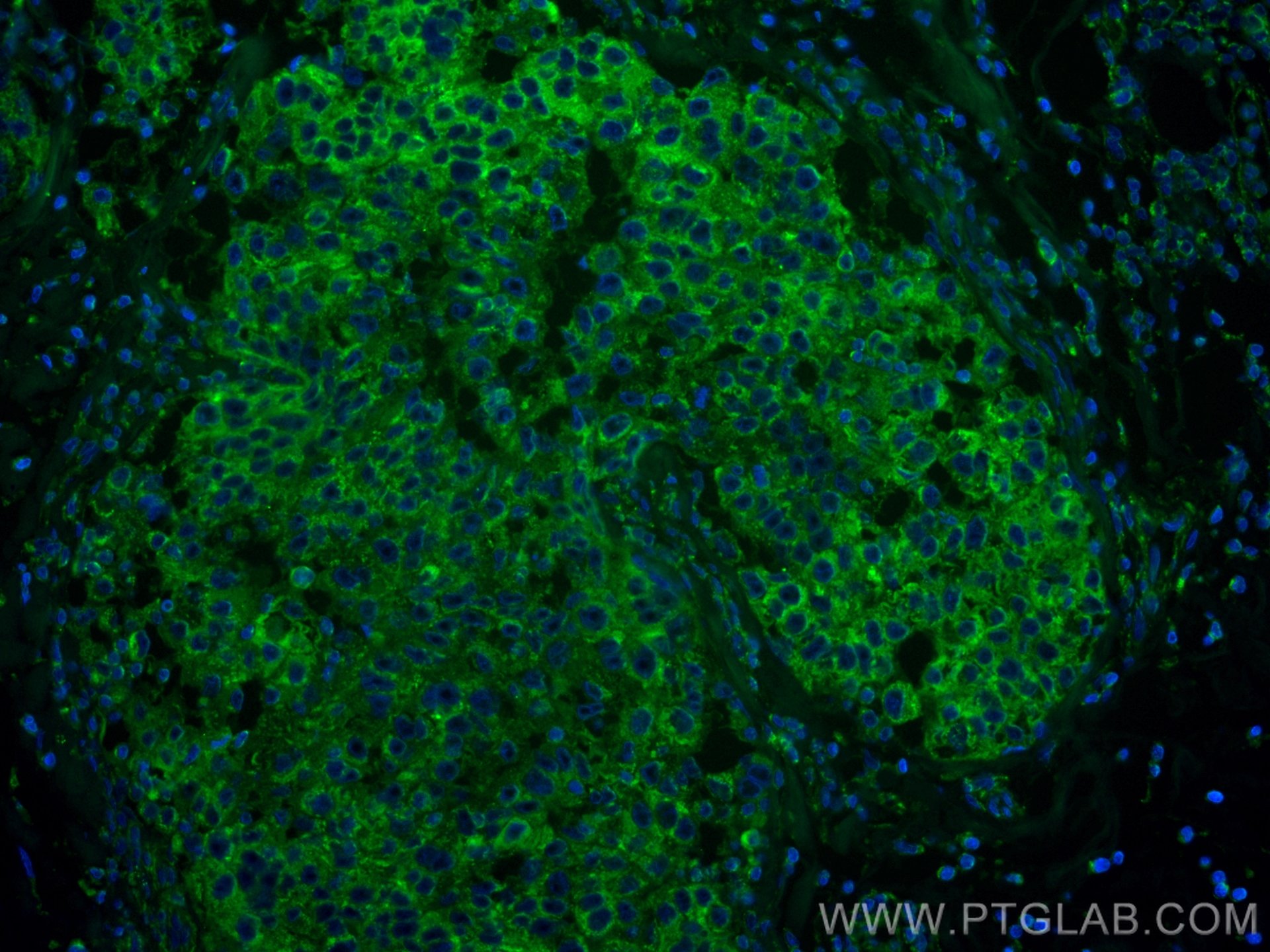 Immunofluorescence (IF) / fluorescent staining of human breast cancer tissue using CoraLite® Plus 488-conjugated RRM1 Monoclonal anti (CL488-60073)