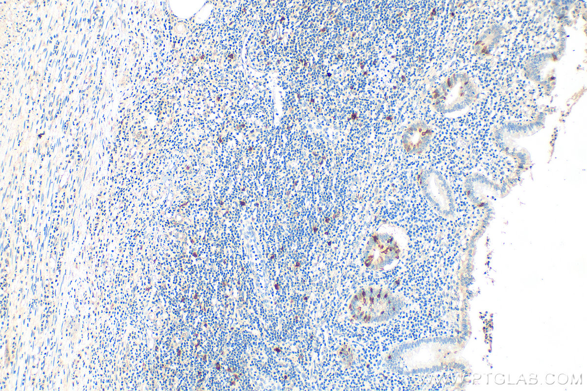 Immunohistochemistry (IHC) staining of human appendicitis tissue using RRM2 Polyclonal antibody (11661-1-AP)