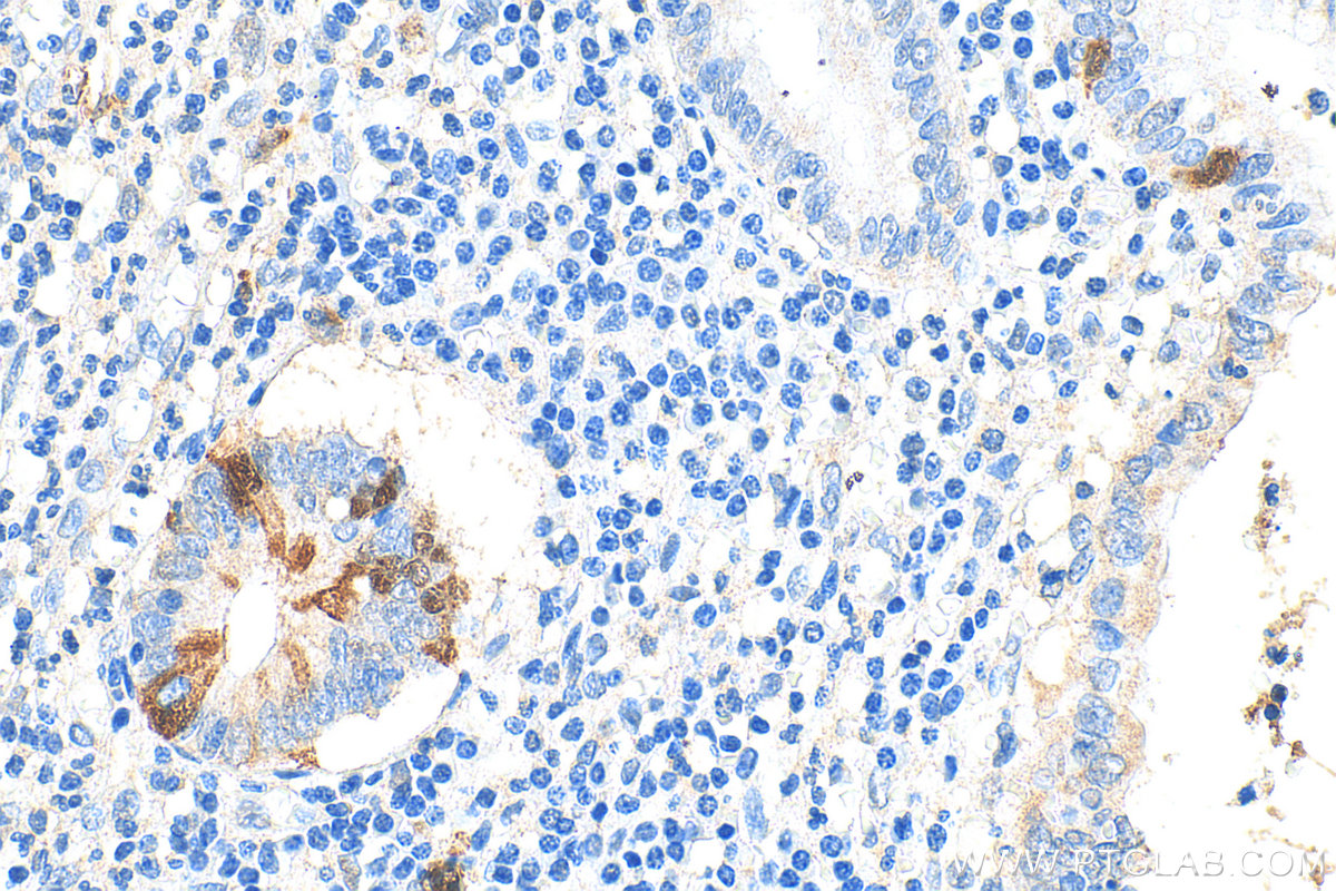 Immunohistochemistry (IHC) staining of human appendicitis tissue using RRM2 Polyclonal antibody (11661-1-AP)