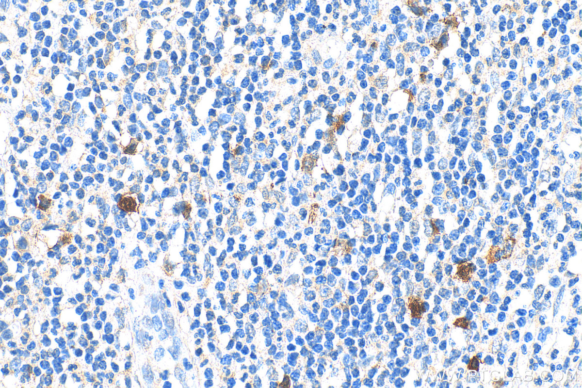 Immunohistochemistry (IHC) staining of human appendicitis tissue using RRM2 Polyclonal antibody (11661-1-AP)